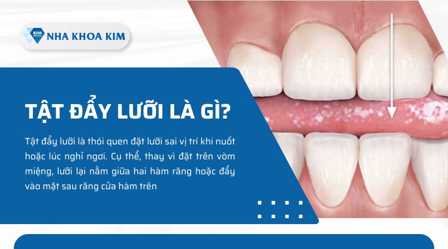 thói quen đẩy lưỡi là gì