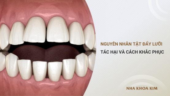 Tật đẩy lưỡi: Nguyên nhân, tác hại và cách khắc phục