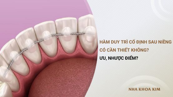 Hàm duy trì cố định sau niềng có cần thiết không? Ưu, nhược điểm