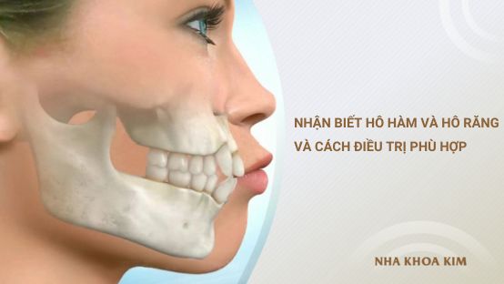 Nhận biết hô hàm và hô răng và cách điều trị phù hợp