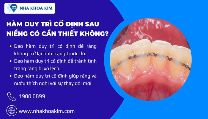 hàm duy trì cố định sau niềng có cần thiết không