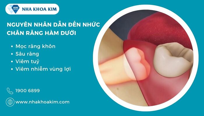 nguyên nhân gây nhức chân răng hàm dưới