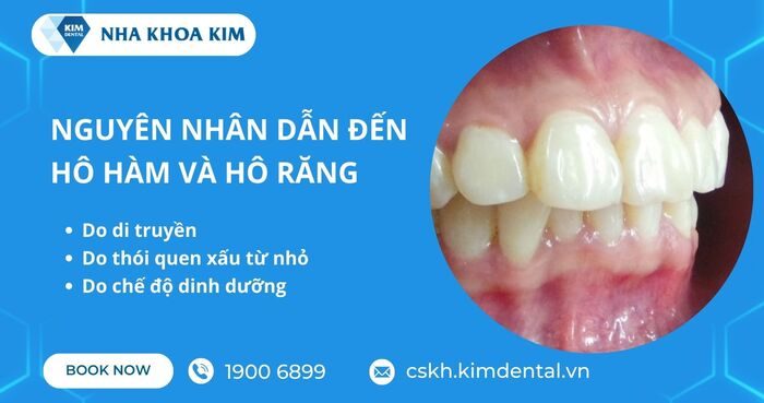 nguyên nhân khiến hàm hô và răng hô