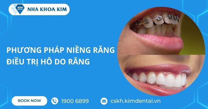 cách điều trị hô răng