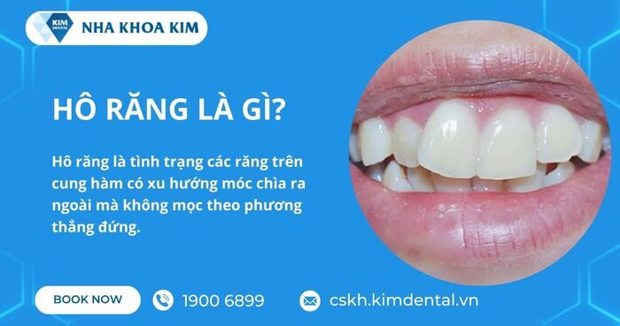 hô răng là gì