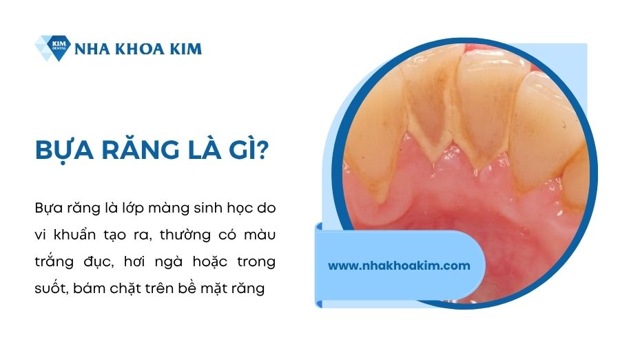bựa răng là gì