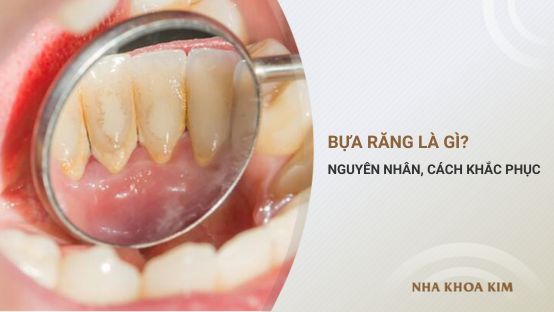 Bựa răng là gì? Nguyên nhân, cách khắc phục