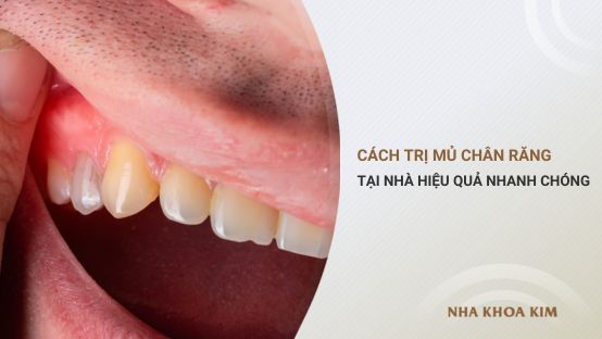 Những cách trị mủ chân răng tại nhà hiệu quả nhanh chóng
