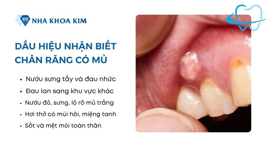 Dấu hiệu viêm mủ chân răng