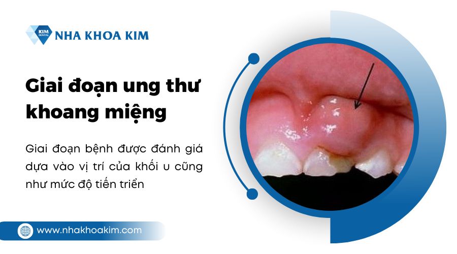 giai đoạn ung thư khoang miệng