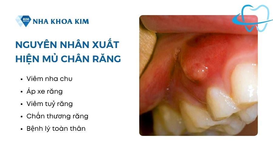 nguyên nhân chân răng tích tụ mủ
