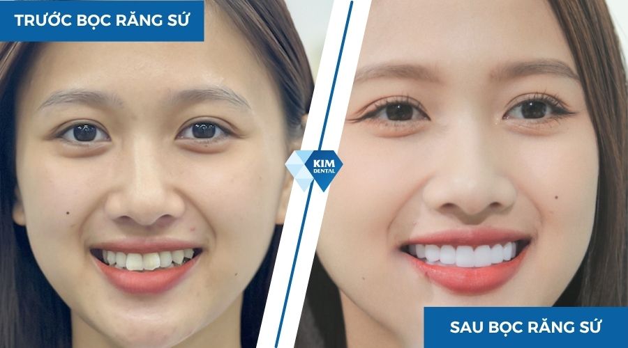 Hành trình thay đổi bản thân bằng bọc răng sứ