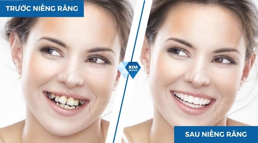 niềng răng nâng cấp cụ cười