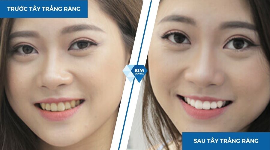 tẩy trắng răng giúp thay đổi bản thân