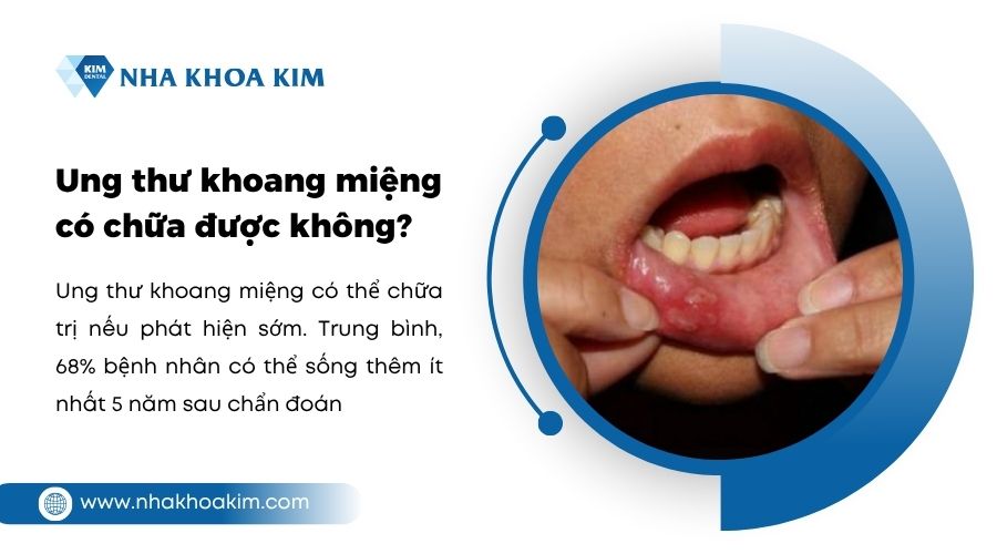 ung thư khoang miệng có chữa được không