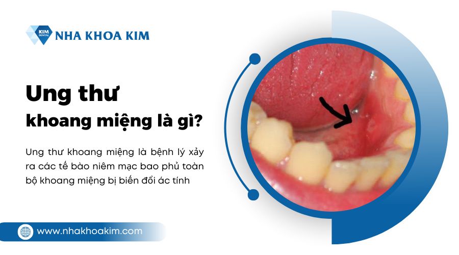 ung thư khoang miệng là gì