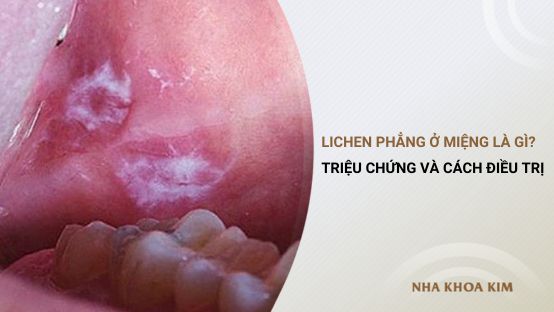 Lichen phẳng ở miệng là gì? Triệu chứng và cách điều trị