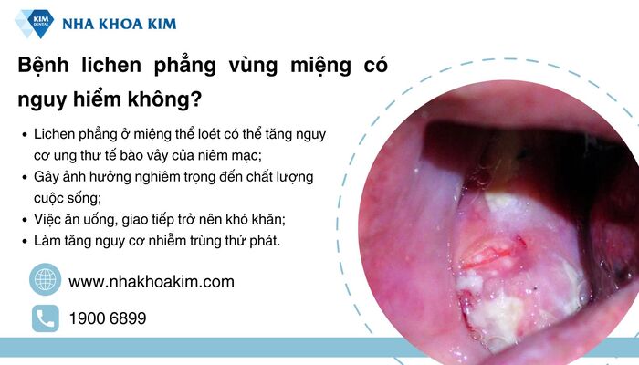 lichen phẳng ở miệng có nguy hiểm không