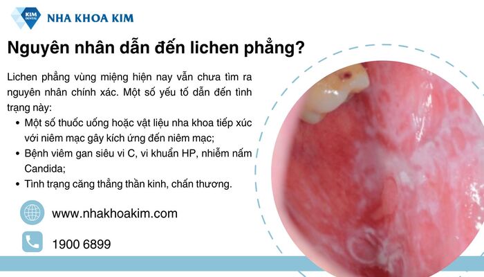 nguyên nhân miệng bị liken phẳng