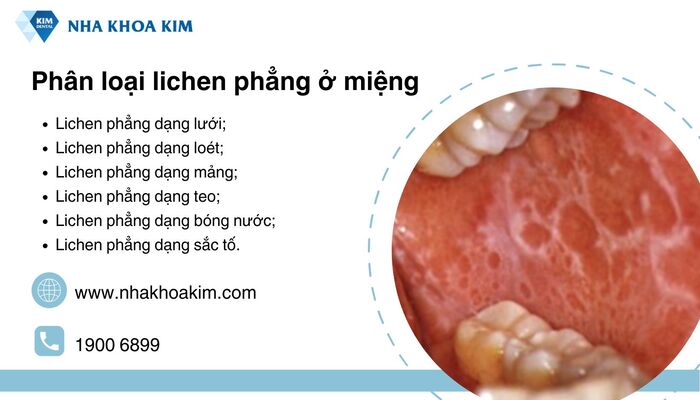các dạng lichen phẳng ở miệng