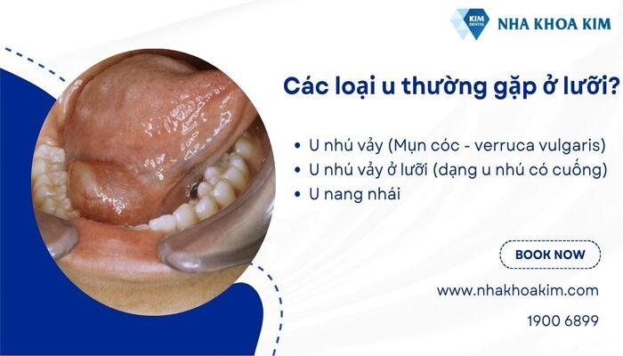 các loại u lưỡi lành tính