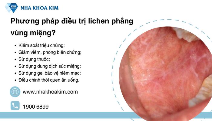 điều trị viêm miệng do lichen phẳng