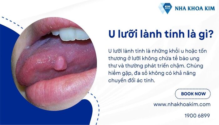 u lưỡi lành tính là gì