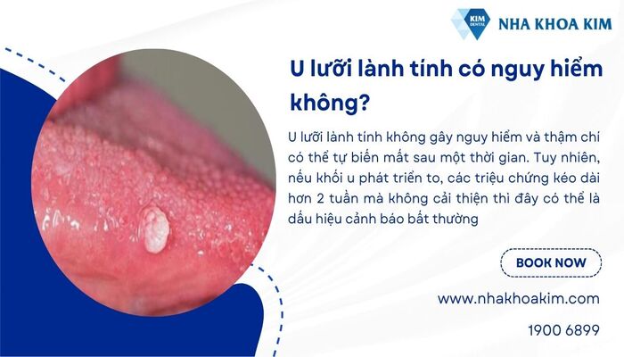 u lưỡi lành tính có nguy hiểm không
