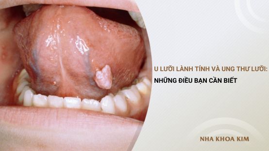 U lưỡi lành tính và ung thư lưỡi: Những điều bạn cần biết