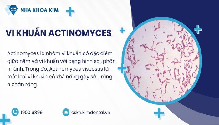 vi khuẩn Actinomyces