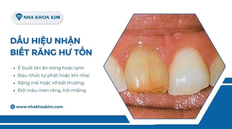 dấu hiệu răng đang bị hư