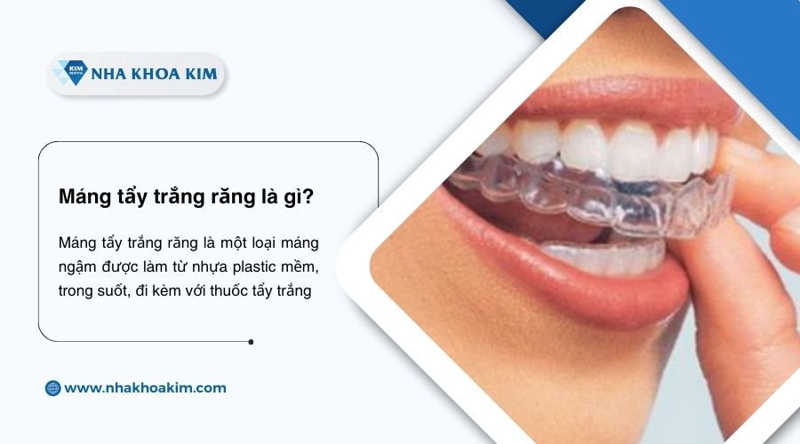 máng tẩy trắng răng là gì