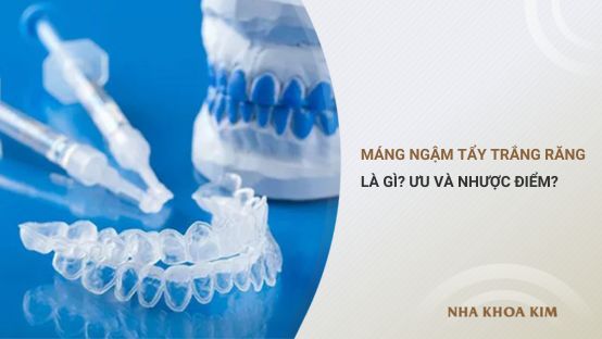 Máng ngậm tẩy trắng răng là gì? Ưu và nhược điểm?