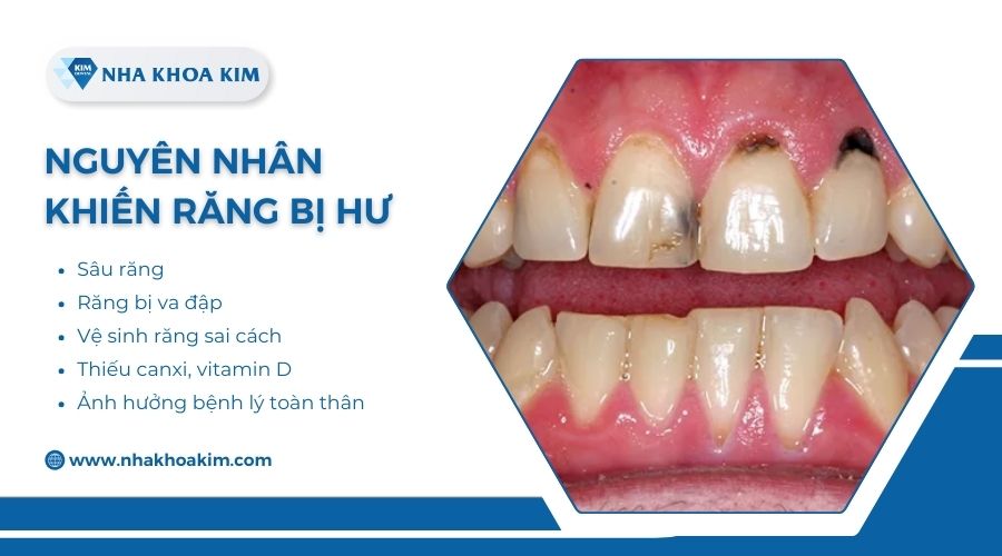Nguyên nhân răng bị hỏng