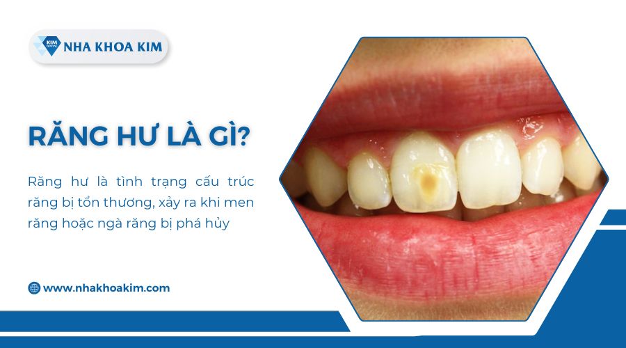 răng hư là gì?