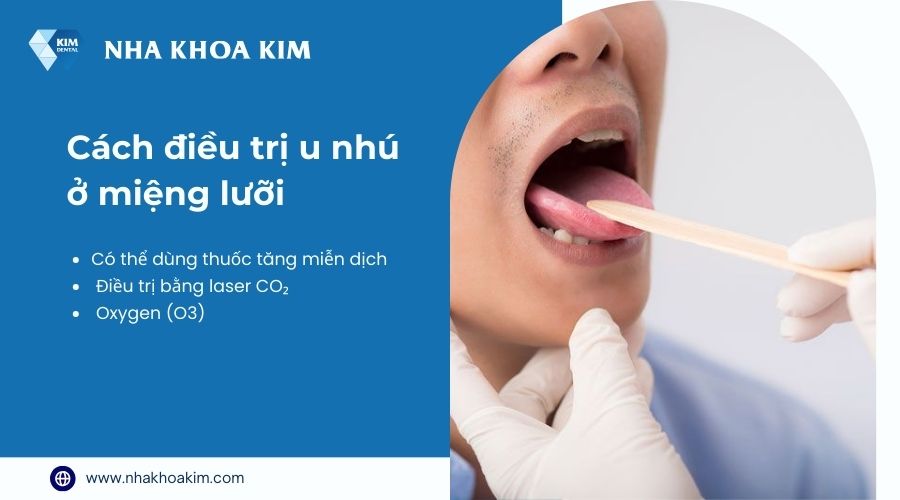 điều trị u nhú tiền đình miệng lưỡi