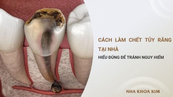 Cách làm chết tủy răng tại nhà: Hiểu đúng để tránh nguy hiểm