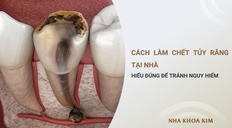 Cách làm chết tủy răng tại nhà: Hiểu đúng để tránh nguy hiểm