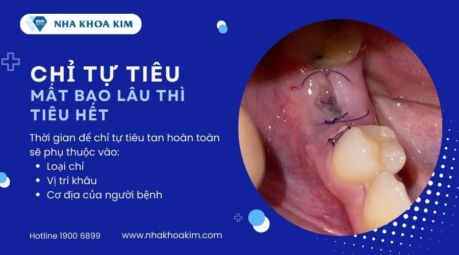 chỉ tự tiêu mất bao lâu thì tiêu hết