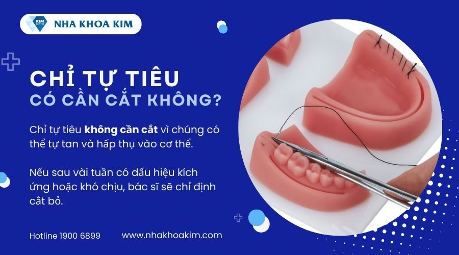 có cần cắt chỉ tự tan không