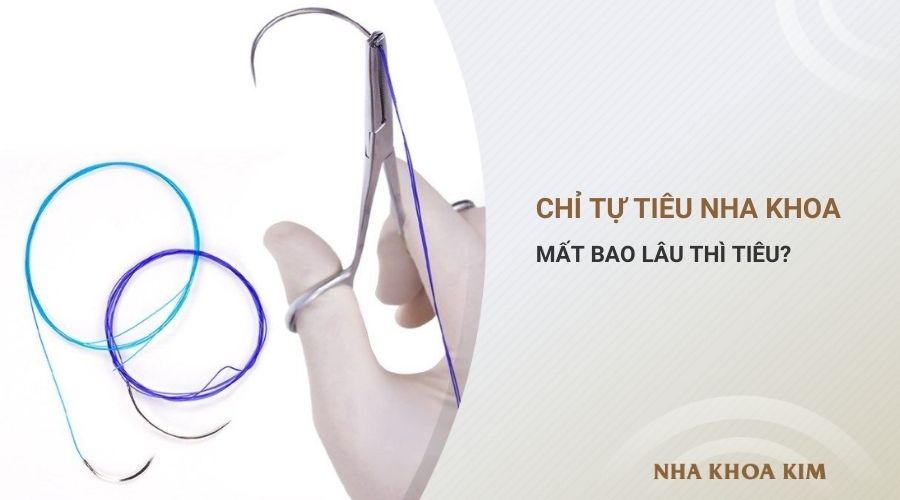 Chỉ tự tiêu là gì? Mất bao lâu thì tiêu?