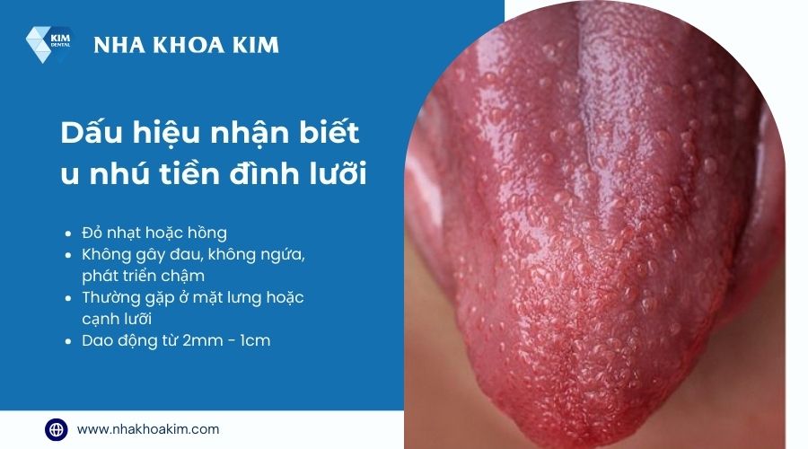 dấu hiệu nhận biết u nhú lành tính ở lưỡi