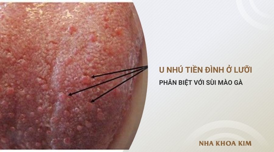 U nhú tiền đình ở miệng lưỡi là gì? Phân biệt với sùi mào gà