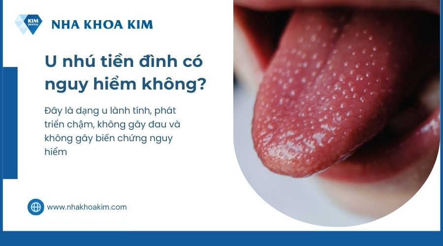 lưỡi nối u nhú có nguy hiểm không