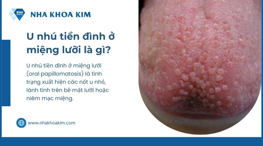 u nhú tiền đình ở lưỡi là gì