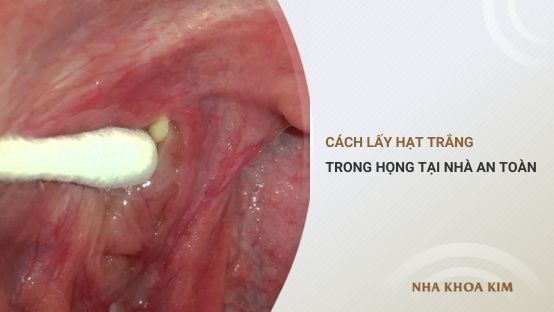 Cách lấy hạt trắng trong họng (sỏi amidan) tại nhà an toàn