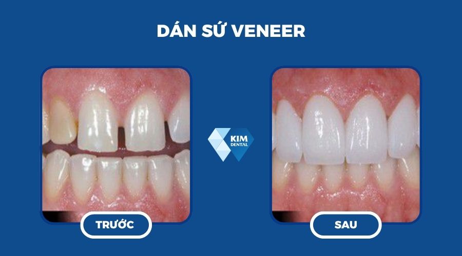 Dán sứ veneer để sở hữu răng hạt bắp