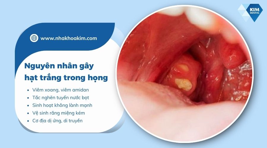 Nguyên nhân hình thành hạt trắng trong họng