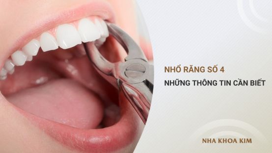 Nhổ răng số 4 và những thông tin liên quan bạn cần biết