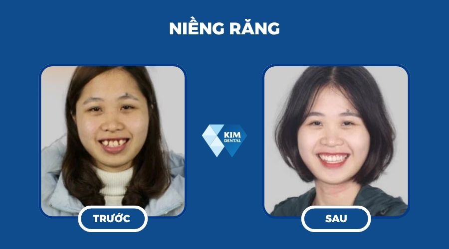 Niềng răng để có răng hạt bắp